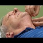 acupuncture