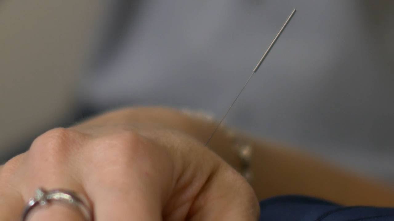 acupuncture