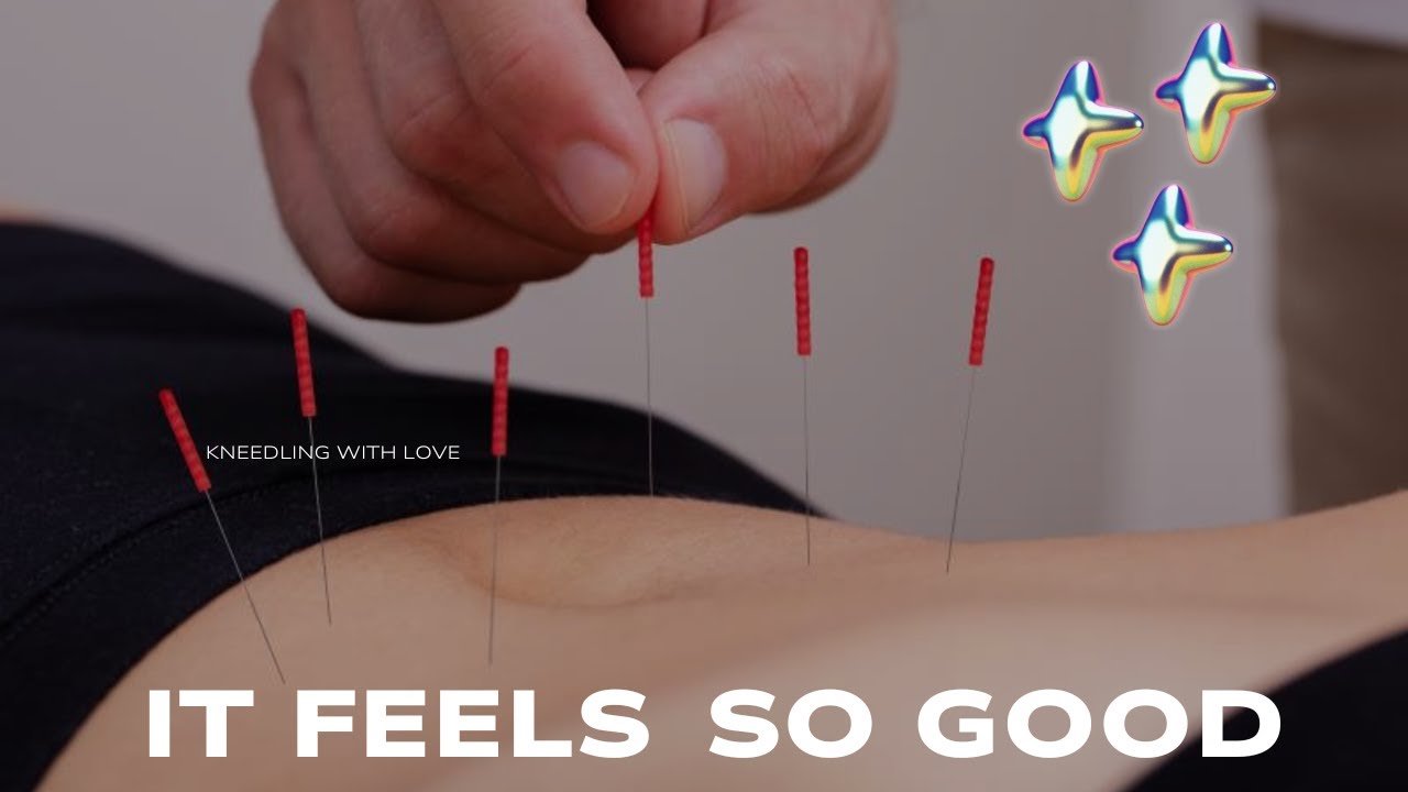 acupuncture