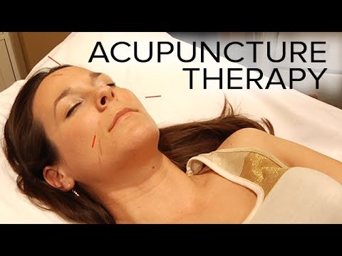 acupuncture