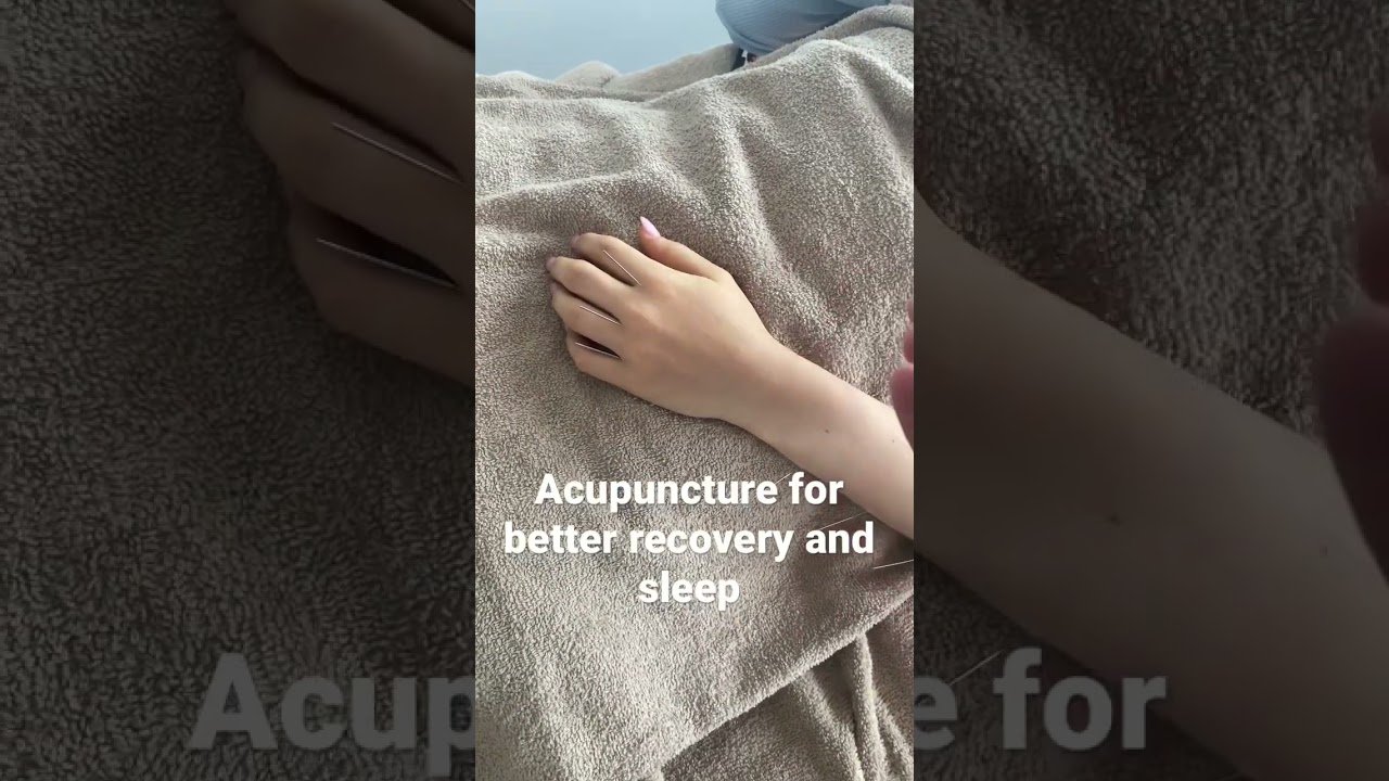 acupuncture