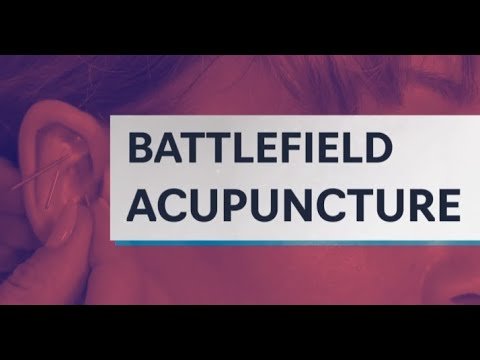 acupuncture