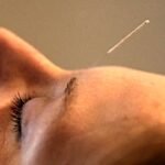 acupuncture