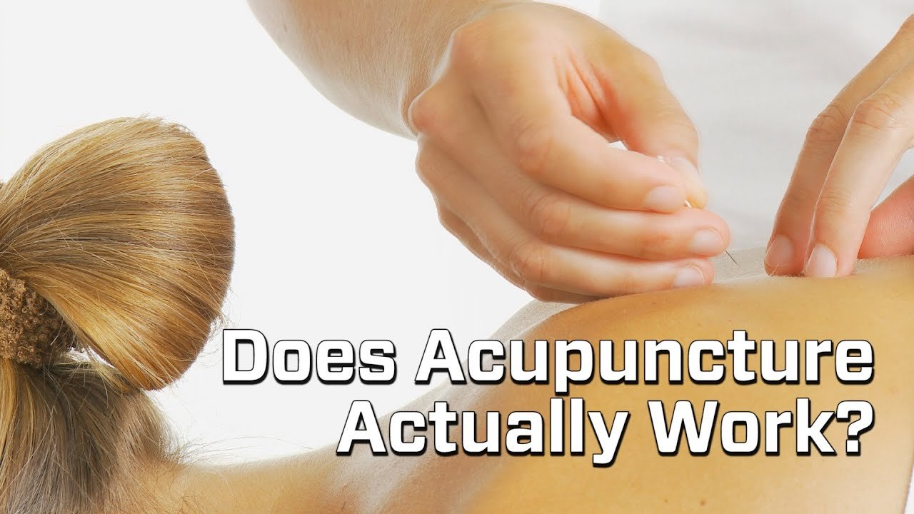 acupuncture