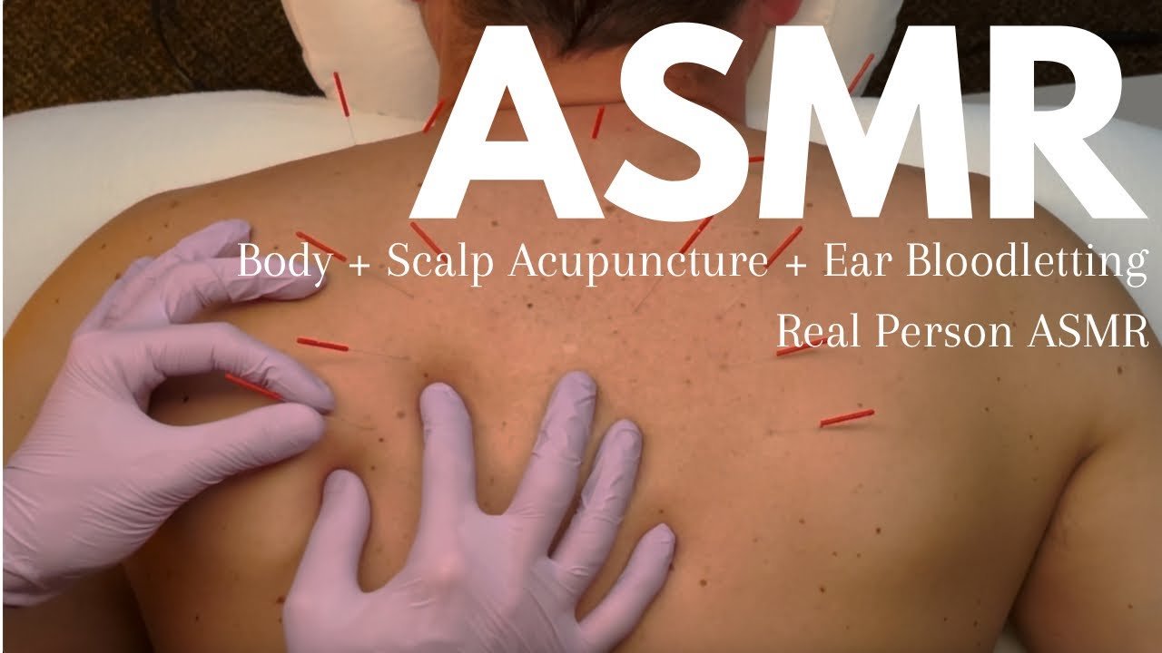 acupuncture